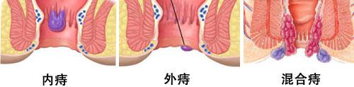 如何判断自己是否患有痔疮