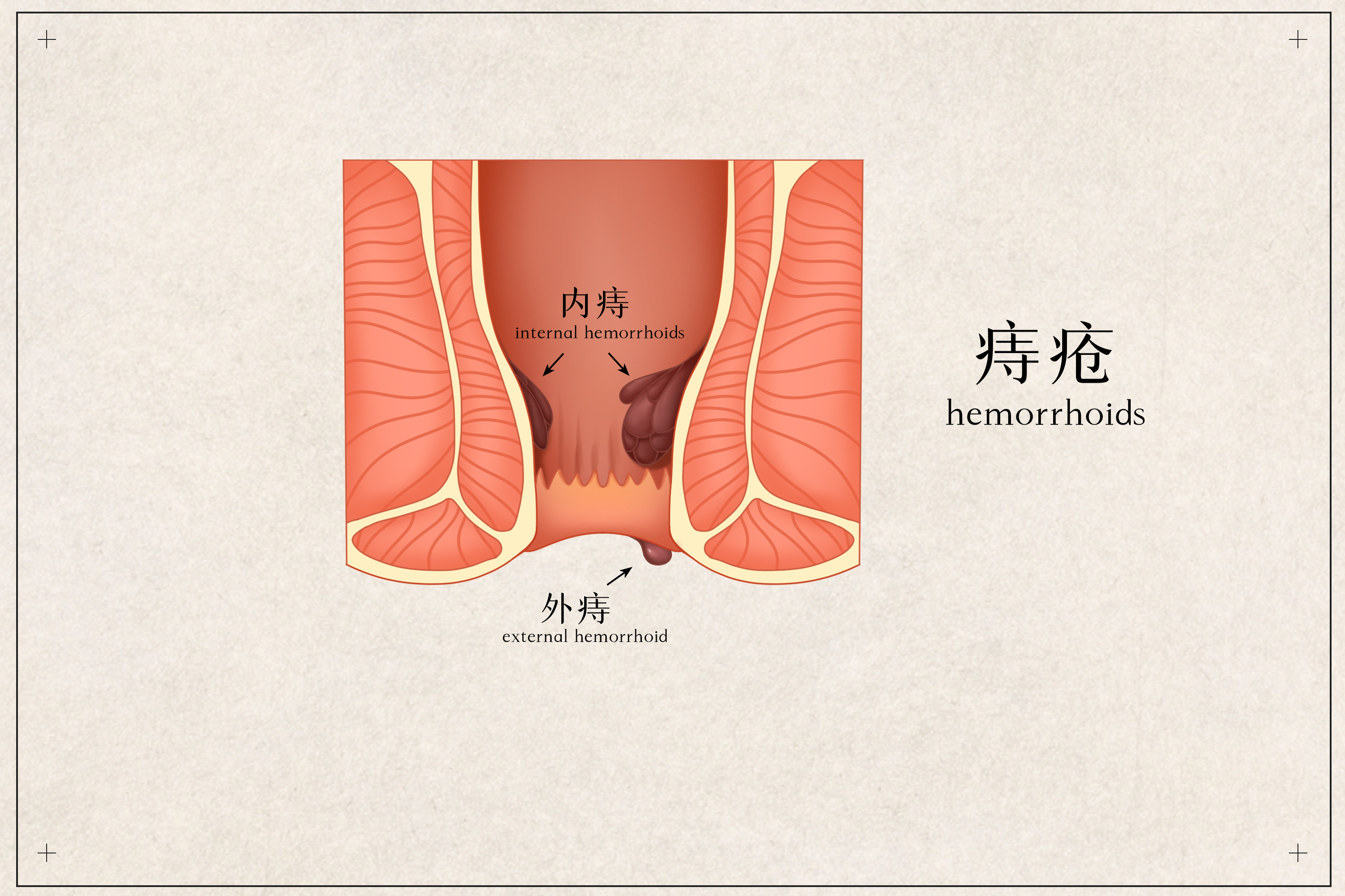 大同肛泰肛肠医院详解痔疮有什么症状表现有哪些