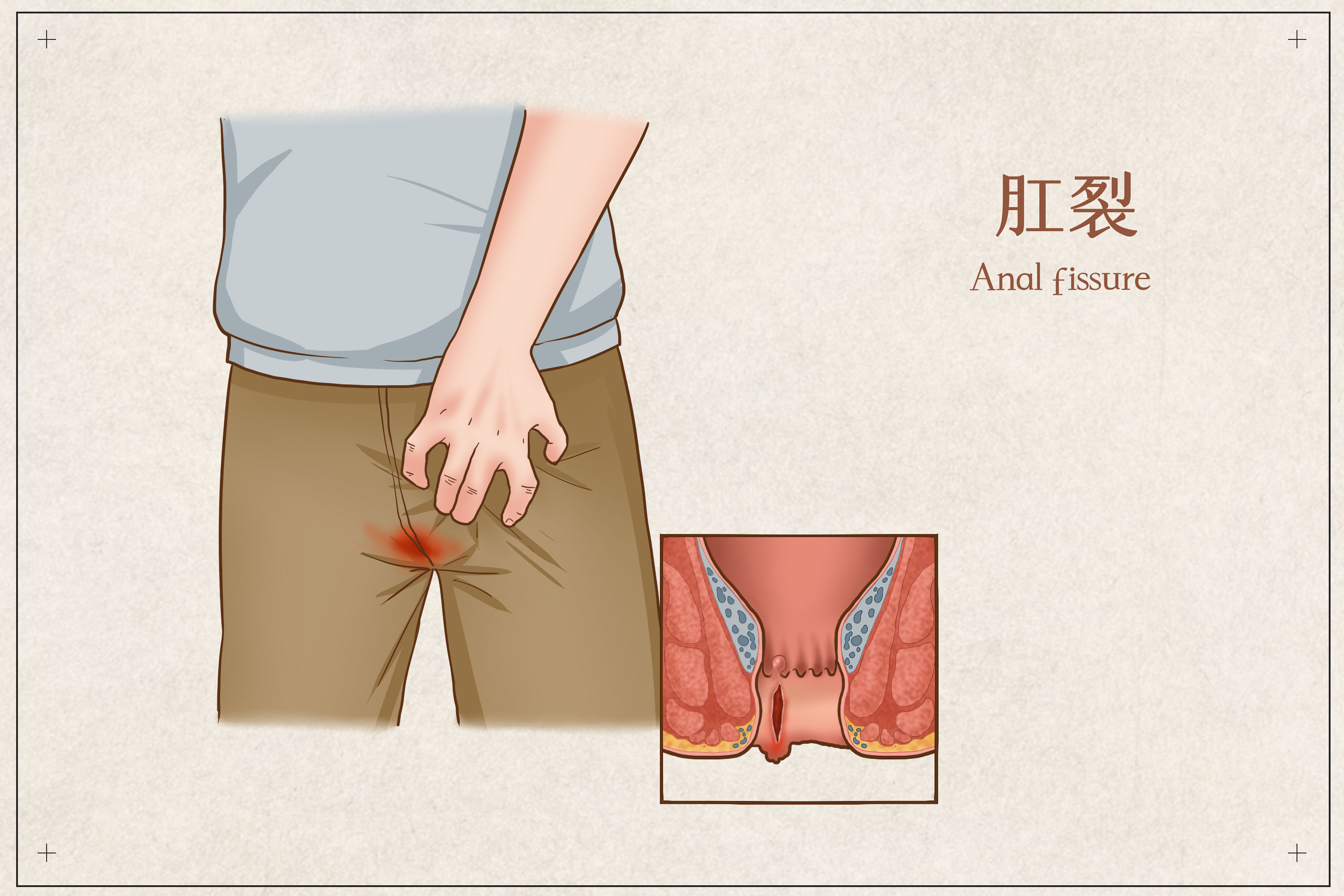 肛裂